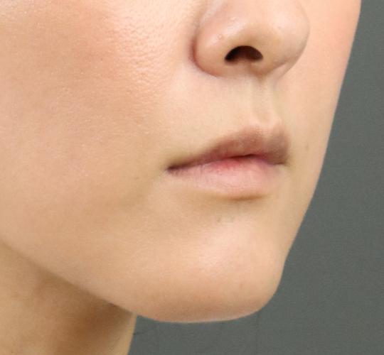 40代女性の人中短縮ボトックス Before 症例写真