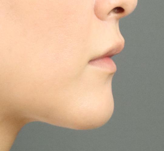 40代女性のヒアルロン酸注射(唇) Before 症例写真