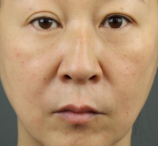 50代女性の再生医療（顔） After 症例写真