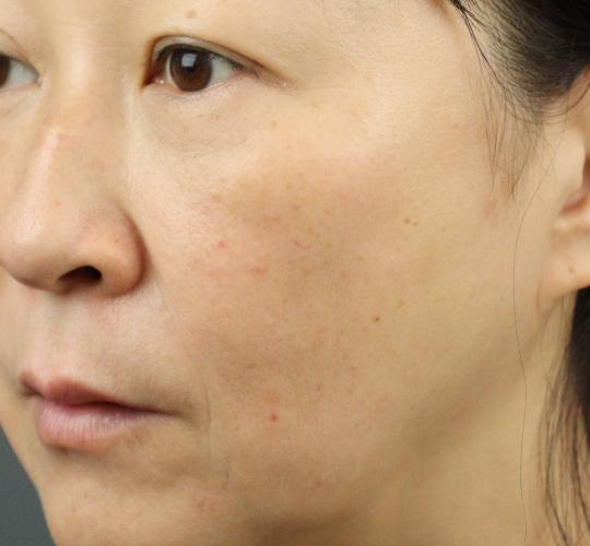 50代女性のACRS（自己血サイトカインリッチ血清） After 症例写真