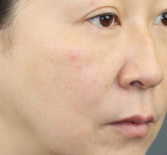 50代女性のACRS（自己血サイトカインリッチ血清） After 症例写真