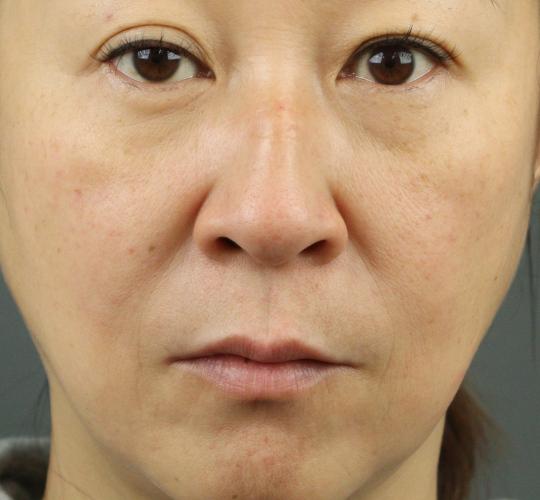 50代女性の再生医療（顔） Before 症例写真