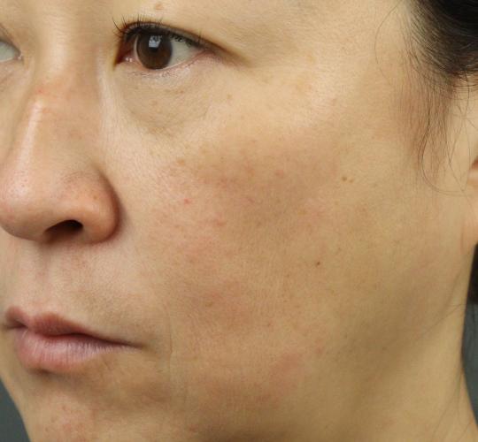 50代女性のACRS（自己血サイトカインリッチ血清） Before 症例写真