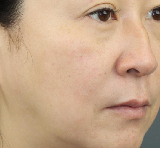 50代女性のACRS（自己血サイトカインリッチ血清） Before 症例写真