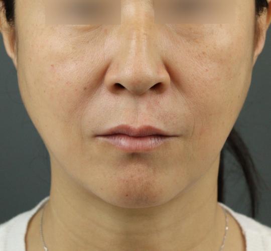 50代女性のヒアルロン酸注射（ゴルゴライン） After 症例写真