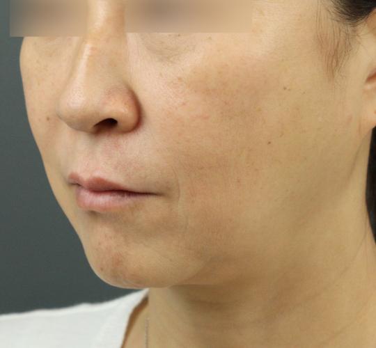 50代女性のヒアルロン酸注射（ゴルゴライン） After 症例写真