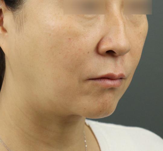 50代女性のヒアルロン酸注射（ゴルゴライン） After 症例写真