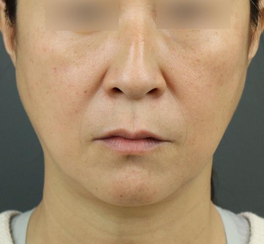 50代女性のヒアルロン酸注射（ゴルゴライン） Before 症例写真