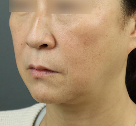 50代女性のヒアルロン酸注射（ゴルゴライン） Before 症例写真