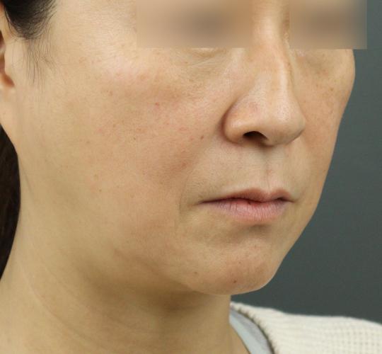 50代女性のヒアルロン酸注射（ゴルゴライン） Before 症例写真