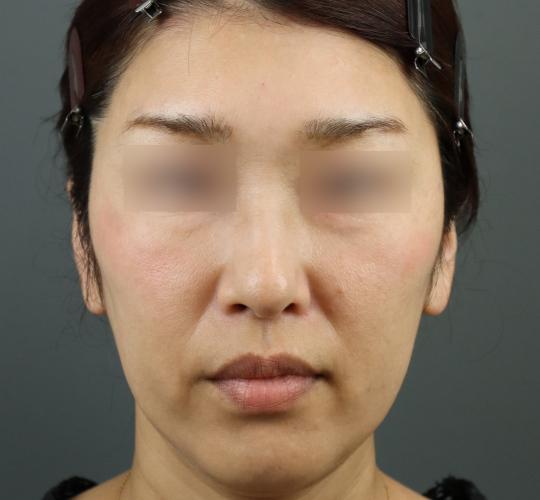 50代女性のヒアルロン酸注射(額) After 症例写真