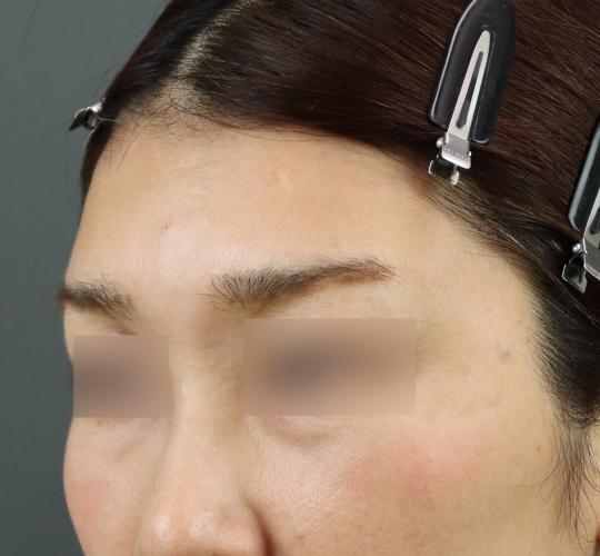 50代女性のヒアルロン酸注射（額） After 症例写真