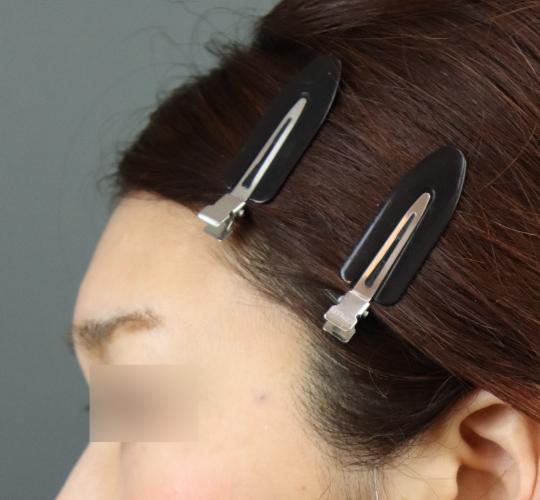 50代女性のヒアルロン酸注射(額) After 症例写真