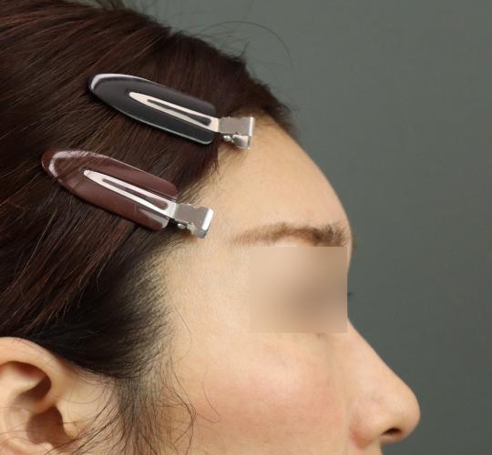 50代女性のヒアルロン酸注射(額) After 症例写真