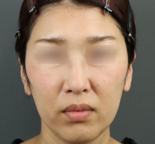 50代女性のヒアルロン酸注射(額) Before 症例写真