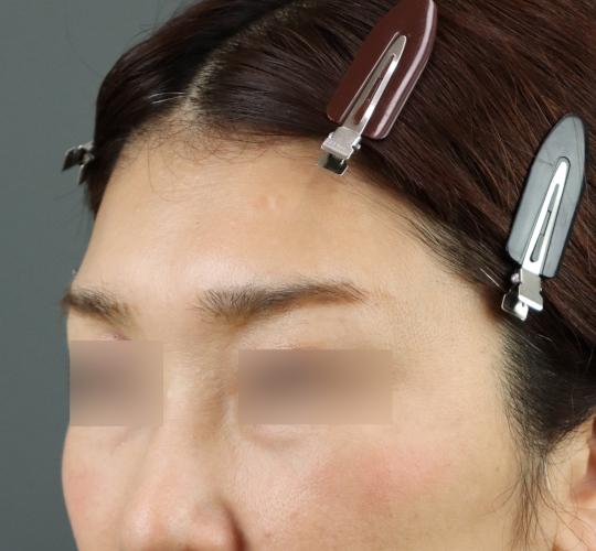 50代女性のヒアルロン酸注射（額） Before 症例写真