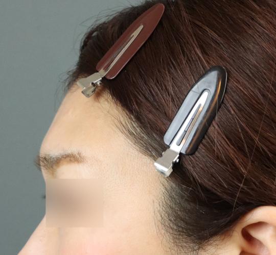 50代女性のヒアルロン酸注射(額) Before 症例写真