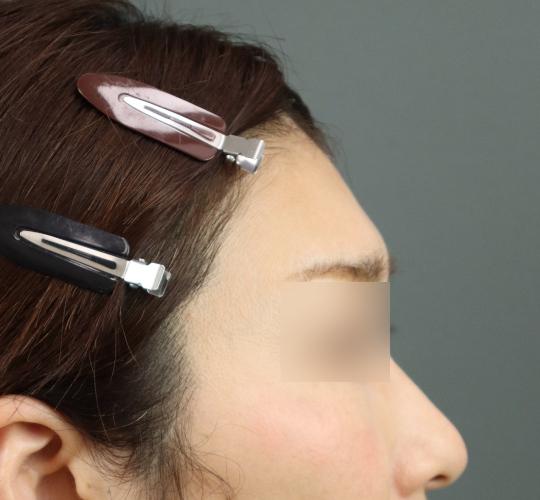 50代女性のヒアルロン酸注射(額) Before 症例写真