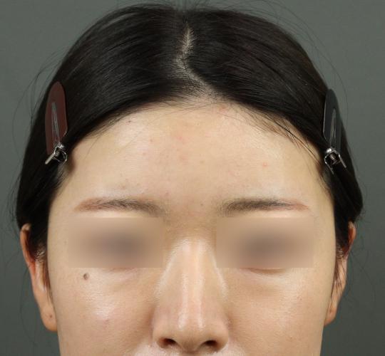 20代女性のヒアルロン酸注射(額) After 症例写真