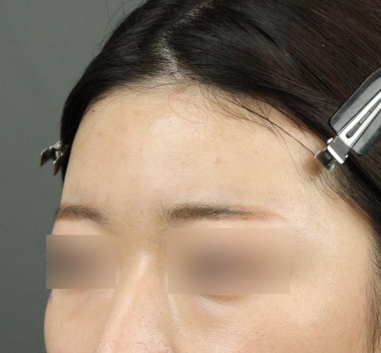 20代女性のヒアルロン酸注射(額) After 症例写真