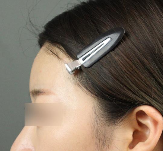 20代女性のヒアルロン酸注射(額) After 症例写真