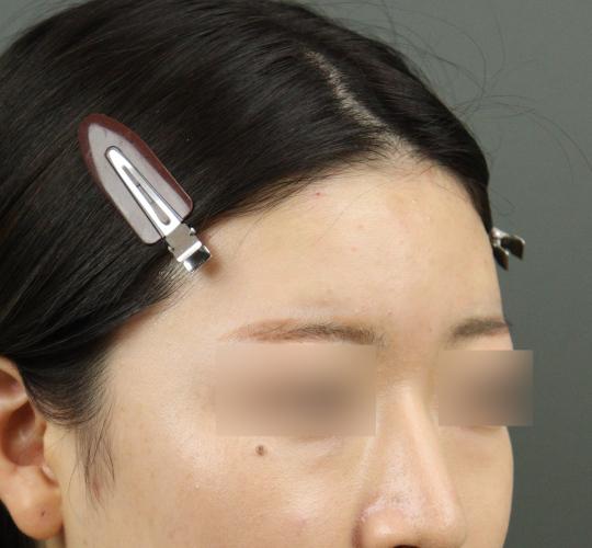 20代女性のヒアルロン酸注射(額) After 症例写真