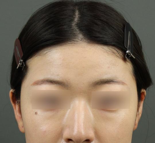 20代女性のヒアルロン酸注射(額) Before 症例写真