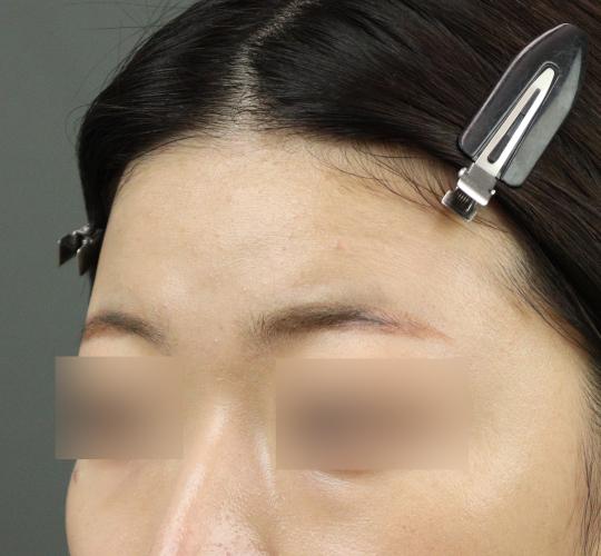 20代女性のヒアルロン酸注射(額) Before 症例写真