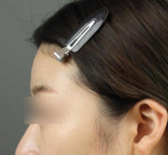 20代女性のヒアルロン酸注射(額) Before 症例写真