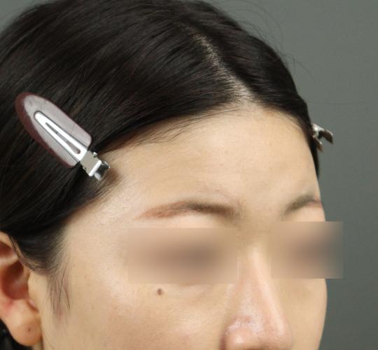 20代女性のヒアルロン酸注射(額) Before 症例写真