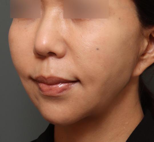 50代女性のメーラーファット除去 After 症例写真