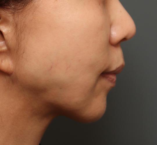 50代女性のメーラーファット除去 After 症例写真