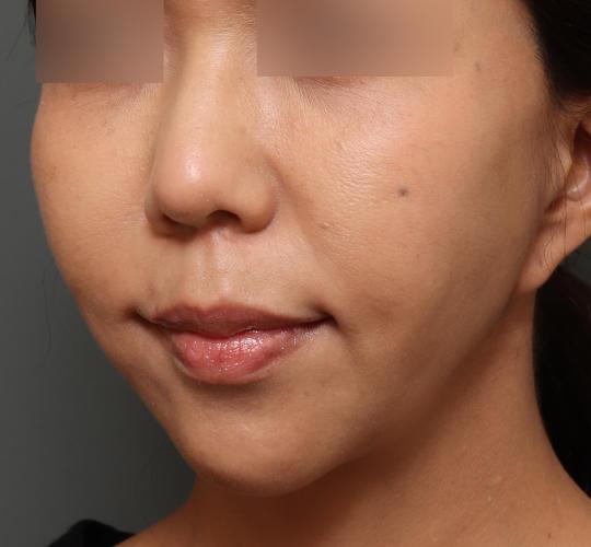 50代女性のメーラーファット除去 Before 症例写真