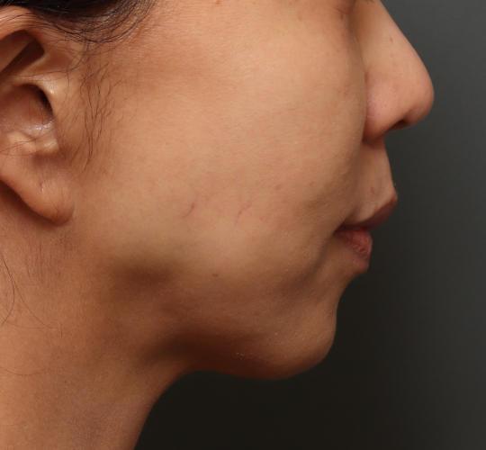 50代女性のメーラーファット除去 Before 症例写真