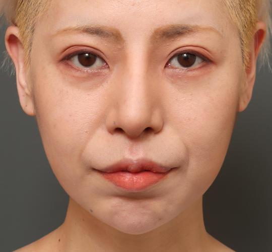 30代女性の鼻中隔延長 After 症例写真