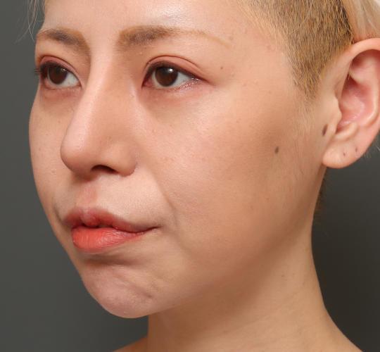 30代女性の鼻中隔延長 After 症例写真