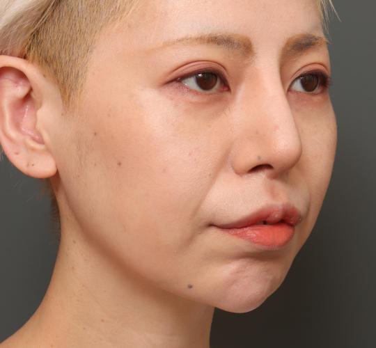 30代女性の鼻中隔延長 After 症例写真