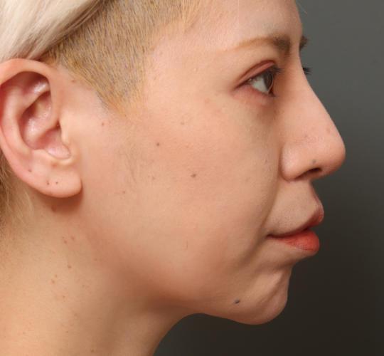 30代女性の鼻中隔延長 After 症例写真