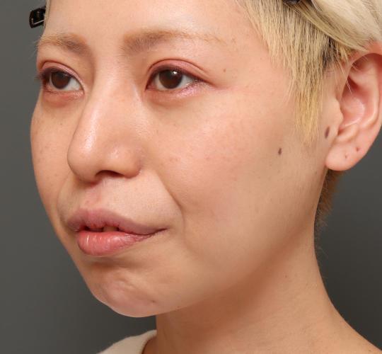 30代女性の鼻中隔延長 Before 症例写真