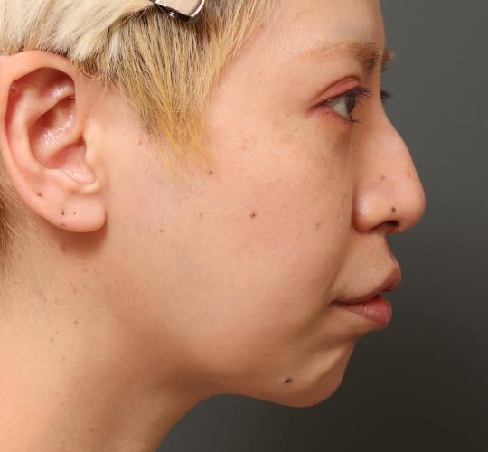 30代女性の鼻中隔延長 Before 症例写真