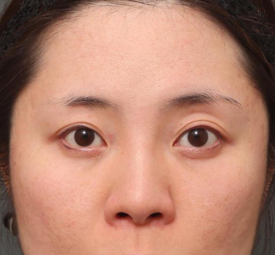 30代女性の3Dリポアイリフト  After 症例写真