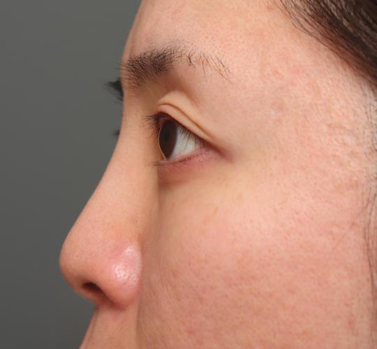 30代女性の3Dリポアイリフト  After 症例写真