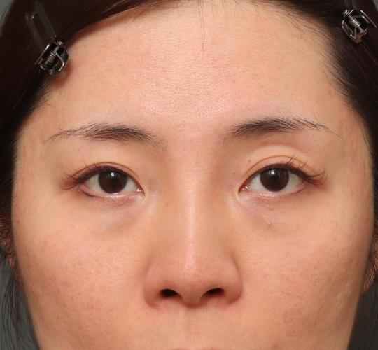 30代女性の3Dリポアイリフト  Before 症例写真