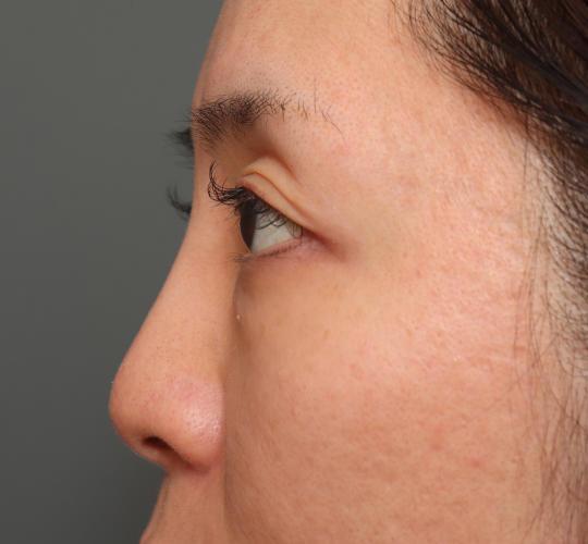 30代女性の3Dリポアイリフト  Before 症例写真