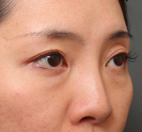 30代女性のハムラ法（目の下のたるみ取り） Before 症例写真