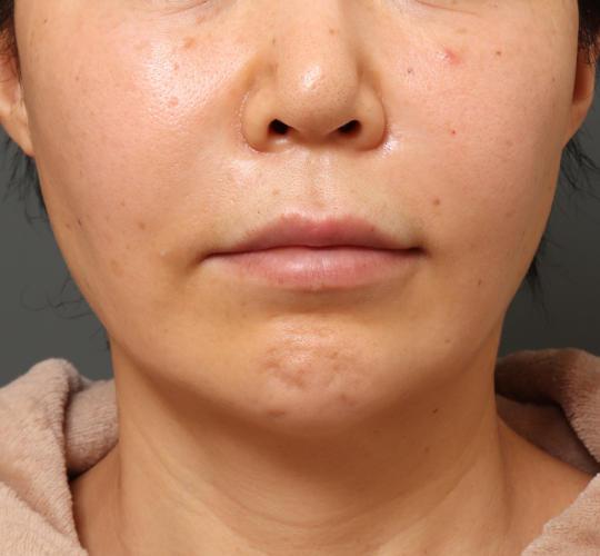 50代女性の人中短縮（リップリフト） Before 症例写真
