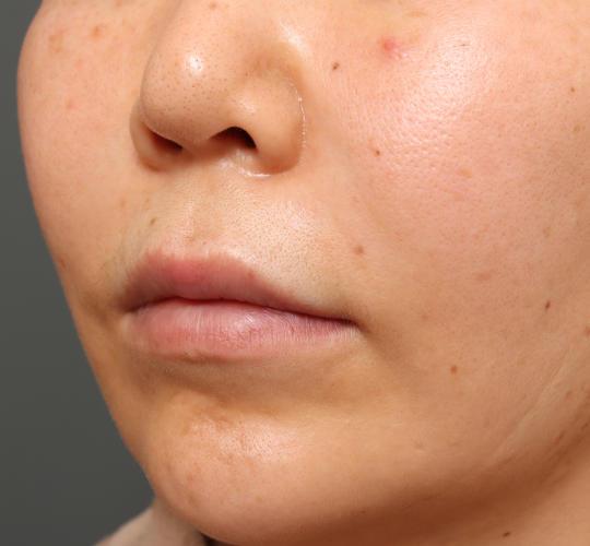 50代女性の唇・口元の整形 Before 症例写真