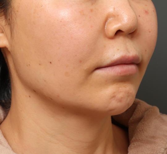 50代女性の人中短縮（リップリフト） Before 症例写真