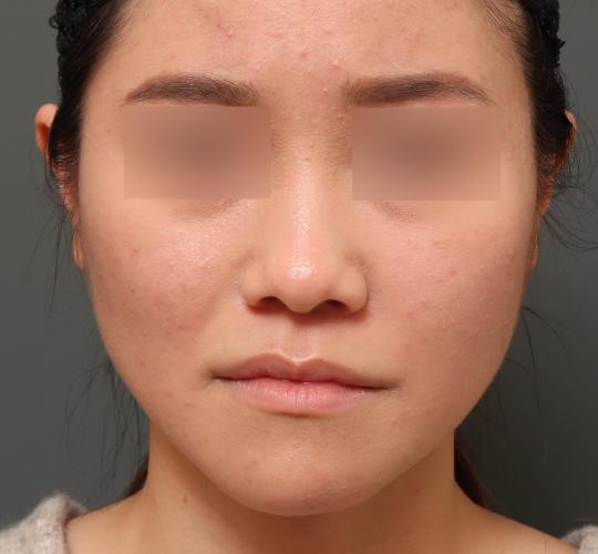 20代女性の鼻プロテーゼ Before 症例写真