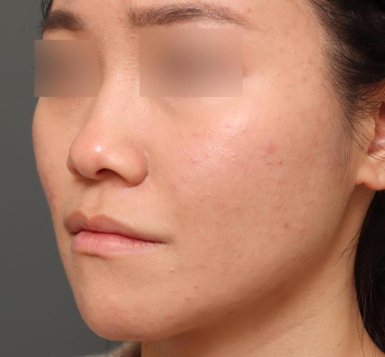 20代女性の鼻プロテーゼ Before 症例写真